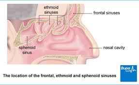 Image result for Sinusitis Prediction Rule