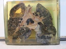 File:8.- Miner's lung with silicosis and tuberculosis.jpg - Wikimedia  Commons