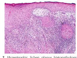 Picture of lichen planus 1. Figure 2 From Hypertrophic Lichen Planus Mimicking Squamous Cell Carcinoma The Importance Of Clinicopathologic Correlation Semantic Scholar