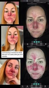 Acne Rosacea- THIS IS AMAZING! 🤩 Ellie came to see me regarding her skin,  and now after using the correct OBAGI products and having regular OBAGI  Skintrinsiq facials, this is now the skin she is ...