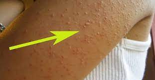 Tienes Estos Granitos En El Brazo Mira Por Que Salen Y Como Desaparecerlos Bioguia