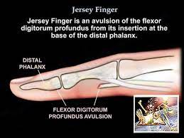 They originate from muscles at about the midforearm. Jersey Finger Everything You Need To Know Dr Nabil Ebraheim Youtube
