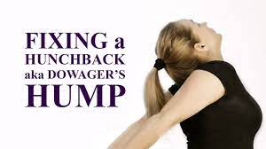The medical description for neck . Fixing A Hunchback Aka Dowager S Hump How To Get Rid Of A Neck Hump Youtube