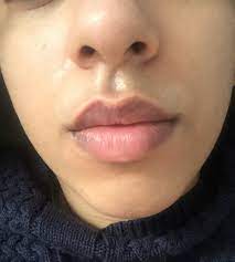 Skin Concerns Increasing Number Of Fordyce Spots On Lips What Can I Do Fragrance Free Products Moisturizer Cream Dermatologist Recommended Skincare