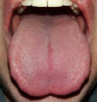 Image result for cancer of tongue