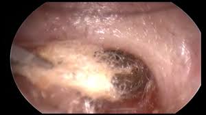 Ce petit garnement aime que l'on s'occupe de lui. Coton Tige Coince Dans L Oreille Q Tip Stuck In The Ear Jb Danvin Orl 1 Youtube