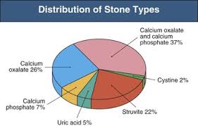 Image result for Calcium Nephrolithiasis