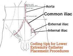 Checkout How To Code The Selective Catheter Placement Cpt Code 36245 36246 36247 36248 For Lower Extremity Procedures Cpt Codes Coding Medical Coding