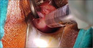 Image result for Paracervical Block