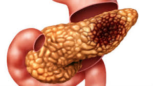 After studying the results of these tests, the physician will know what kind of cancer you have, what the best treatment options are and your prognosis, or. Pancreatic Cancer Patients Should Be Offered Early Scans To Avoid Unnecessary Surgery Says Nice News And Features News Nice