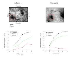 With regards to anything, not just nervous system, ipsilateral means 'same side' and contralateral hypothetically, if you are reading something like 'a left hemispheric lesion causing ipsilateral motor. Response Of Si Cortex To Ipsilateral Contralateral And Bilateral Flutter Stimulation In The Cat Bmc Neuroscience Full Text
