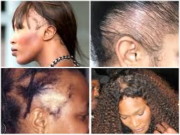 Whether a person's hair loss is a natural occurrence due to genetics and aging or is caused by a medical issue like alopecia areata, hormonal imbalances, or other disorders, a receding hairline can. Everything You Need To Know About Traction Alopecia Curlynikki Natural Hair Care