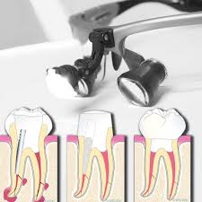 Revision Der Wurzelbehandlung Endospezialist In Muenster