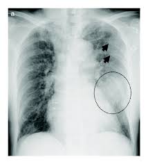 Image result for Pulmonary Contusion