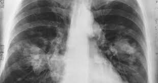 Image result for lung cancer xray