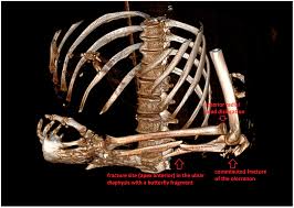 Image result for Radial Head Dislocation