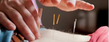 Check spelling or type a new query. Medicare Now Covers Acupuncture The Martha S Vineyard Times