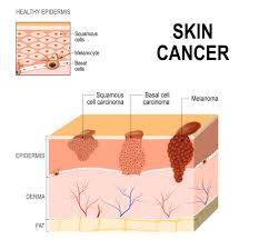 To help you spot bcc before it grows deep into your skin, dermatologists share these 7 warning signs that could be easily missed. What To Watch Out For Early Signs Of Skin Cancer