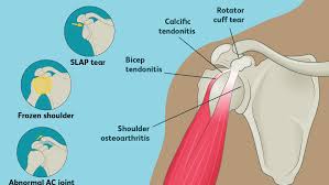 A slap repair is an arthroscopic shoulder surgery using sutures to reattach the torn labrum back to the bone of the shoulder socket. Anatomy Of The Human Shoulder Joint