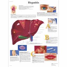 hepatitis