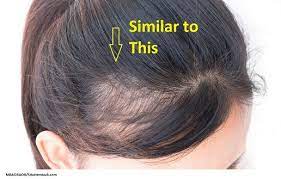 Diffuse hair loss in women: Postpartum Hair Loss My Experience And Tips For Healthy Hair