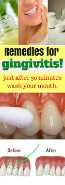 Gingivitis Or Known As Gum Disease Is A Very Common Dental Condition That Can Affect Anyone Its Symptoms Are Swoll Gum Disease Treatment Gum Health Gingivitis