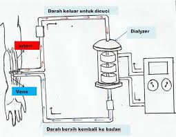 Specialize in capd dialysis, renal failure and kidney function. Dialisis Wikipedia Bahasa Melayu Ensiklopedia Bebas