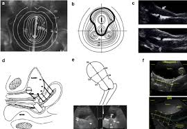 Examples Of Ultrasound Measurements Of Uterus Used To Guide Download Scientific Diagram Intermittent myometrial contractions and changes in uterine shape and position are normal during some of the alterations in the shape of the uterus during pregnancy, such as transient asymmetry related to early gestation (piskacek uterus) or. examples of ultrasound measurements of