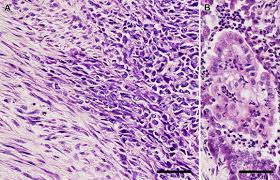 The iaslc/imig mesothelioma registry found that histology, age, sex, and white blood cell and platelet counts stratified survival for 906 patients 138; Mixed Form Of Pericardial Mesothelioma With Osseous Differentiation In A Dog Sciencedirect