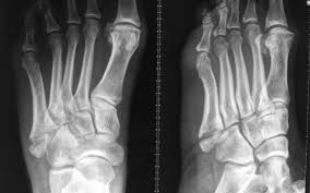 A foot avulsion injury commonly occurs in the 5th metatarsal and is often referred to as a dancer's fracture. Foot Fractures Hc Chang Orthopaedic Surgery Singapore