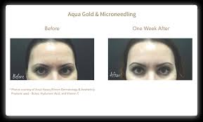 The needles used in aquagold are much finer than those used in microneedling; Aqua Gold Microneedling Mecca Spa Nj