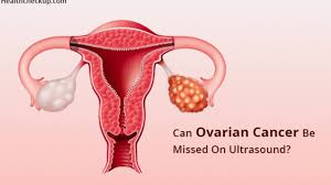 We talked to experts about why that is. Can Ovarian Cancer Be Missed On Ultrasound Health Checkup