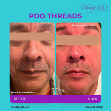 ✨ Turn back time with PDO Thread Lifts! ✨ Discover the magic of a  non-surgical facelift at VanityMD performed by board-certified physician  Dr. Kimberly Gilbert MD. Our PDO threads are the secret