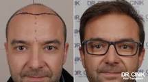 5000-Graft Hair Transplant: Cost and Candidacy Factors