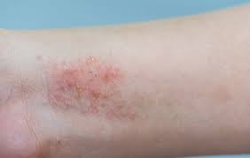 Rashes that can cause extreme itchiness, which may interfere with sleeping. Ease Your Itchy Skin With These 8 Best Eczema Treatments Prevention