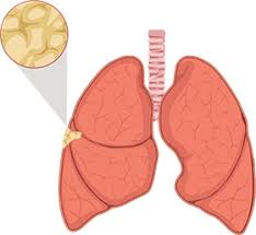 Mesothelioma metastasis occurs when the cancer has spread beyond where the tumors originated, generally associated with stage 3 and stage 4 mesothelioma. Mesothelioma What Is Mesothelioma Cancer
