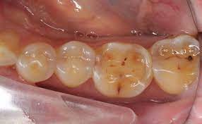 牙齒琺瑯質可直接被酸帶走牙膏成分可幫助「再礦化」