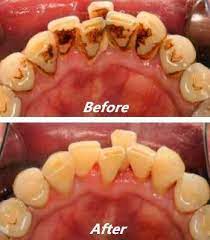 Pin On Teeth Whitening