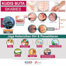 We did not find results for: Kudis Buta Adalah Jabatan Kesihatan Negeri Pulau Pinang Facebook