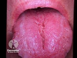 Image result for Fissured tongue