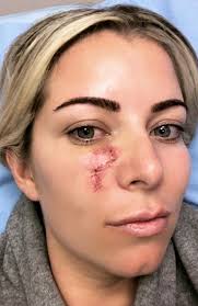 There are a number of different treatments doctors recommend. Australian Mum Reveals Blind Pimple Was Diagnosed As Aggressive Skin Cancer News Com Au Australia S Leading News Site