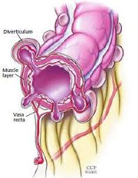 Colonic Diverticular Disease
