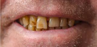 Image result for Tooth Discoloration