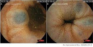 Blue Rubber Bleb Nevus Syndrome In Geriatric Patients Revista De Gastroenterologia De Mexico