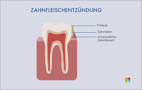 So schön und gemütlich das schwabenannerl auch ist, im winter konnte es ganz schön kalt werden im schlafzimmer. Karies Das Loch Im Zahn Vorbeugen Und Heilen Casa Dentalis