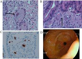 Although hsv esophagitis is much more common in immunosuppressed individuals, it can occur in healthy persons. Viral Infections After Kidney Transplantation Cmv And Bk Intechopen