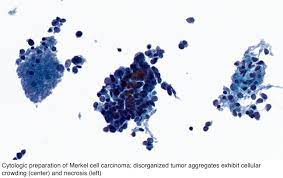 Merkel cell carcinoma typically affects older adults and the tumour usually starts in a sun exposed area such as the head or neck. Pathology Outlines Merkel Cell Carcinoma