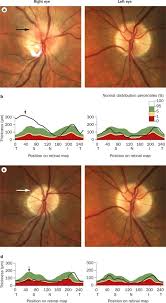 Vezi aici pe site camera 309 episodul 160 tradus din data de 21 aprilie 2018 online hd, gratuit fara intreruperi. The Optic Nerve Head In Acquired Optic Neuropathies Nature Reviews Neurology