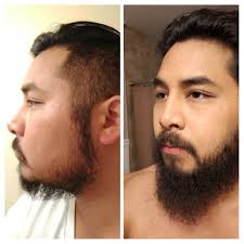 How long does minoxidil beard take? Minoxidil Beard