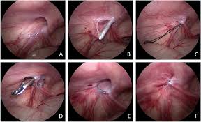 Image result for Inguinal hernia child